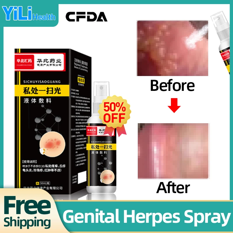 Herpes Shingles Treatment Spray for Men and Women Genital Herpes Simplex Cure Medicine Cream 50ml/bottle CFDA Approval