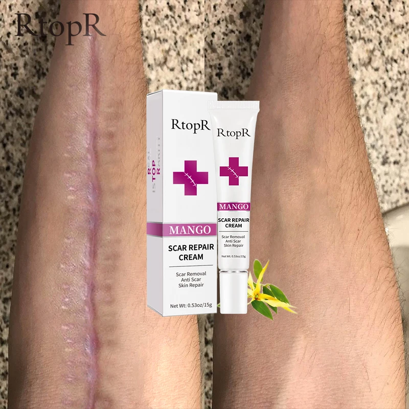 

Defrost skin scar, fade facial scar cream, treat acne spots, blackhead whitening cream, anti-scar stretch marks and beauty 1pcs