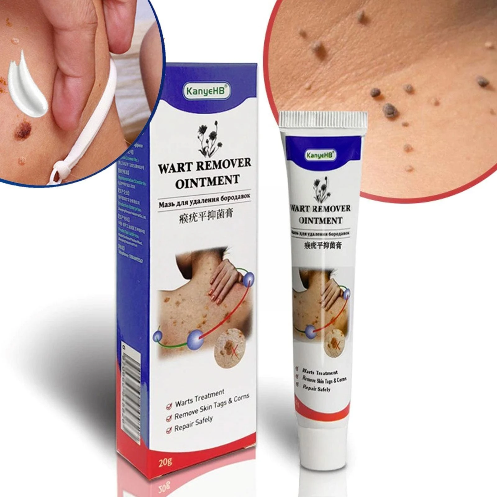 20g Wart Remover Ointment Genital Herpes Genital Antibacterial