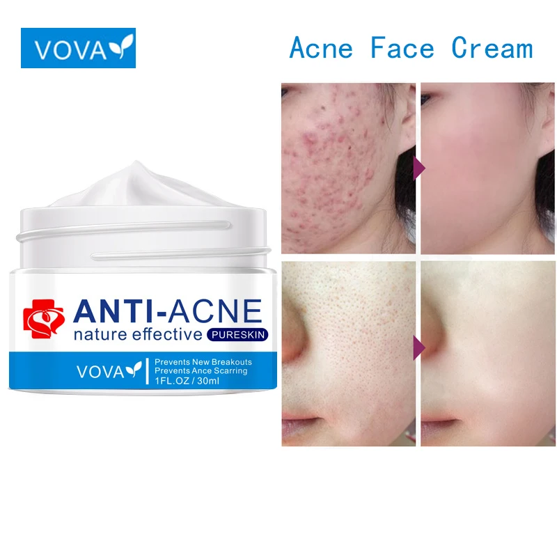 Vova Acne Face Cream Treatment Acne Lighten Acne Marks Oil Control Anti