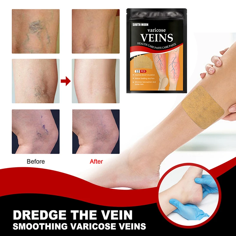 South Moon Varicose Veins Phlebitis Spider Earthworm Leg Relief Patch Anti Swelling for Foot Health Care Removal Pain 12pcs