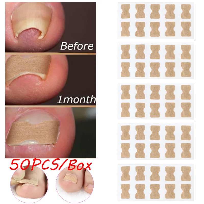 

50pcs Nail Correction Stickers Ingrown Paronychia Treatment Toenail Corrector Patches Waterproof Recover Corrector Pedicure Tool