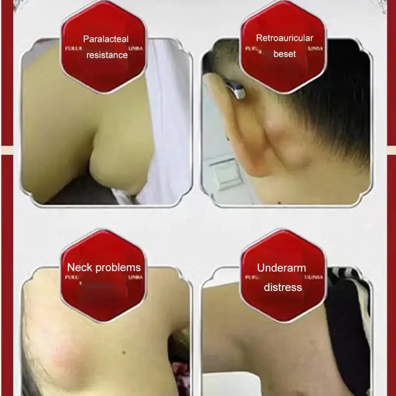 Lipoma Removal Cream 20g Relief Pain Treat Skin Swelling Lipolysis Cellulite Remover Ointment Lipolysis Fat Lump Body Care