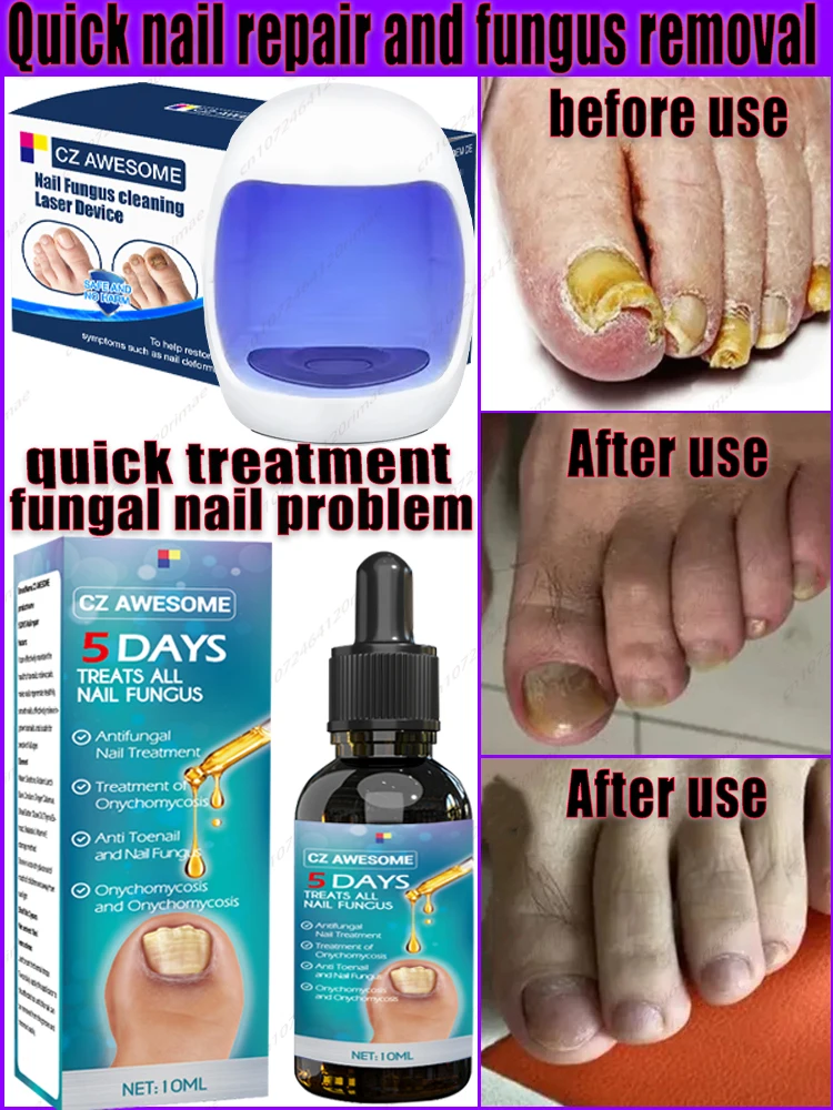 

Fungal Nail Laser Device, Fast Onychomycosis Fungal Nail Repair