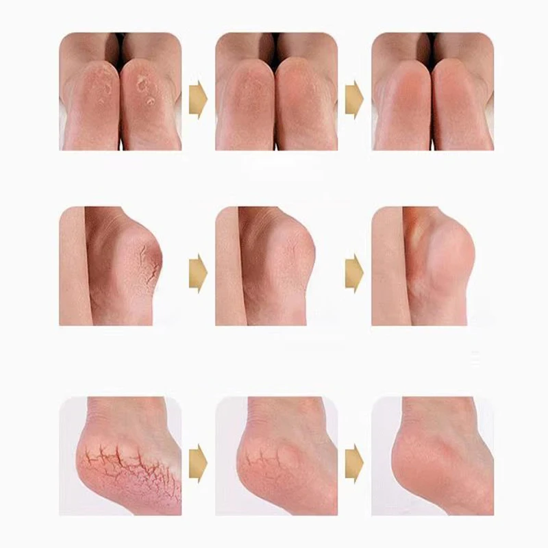 젤 풋 케어 양말, 통증 완화, 균열 방지, 보습, 각질 제거, 천공 실리콘 풋 케어 도구, 1 쌍