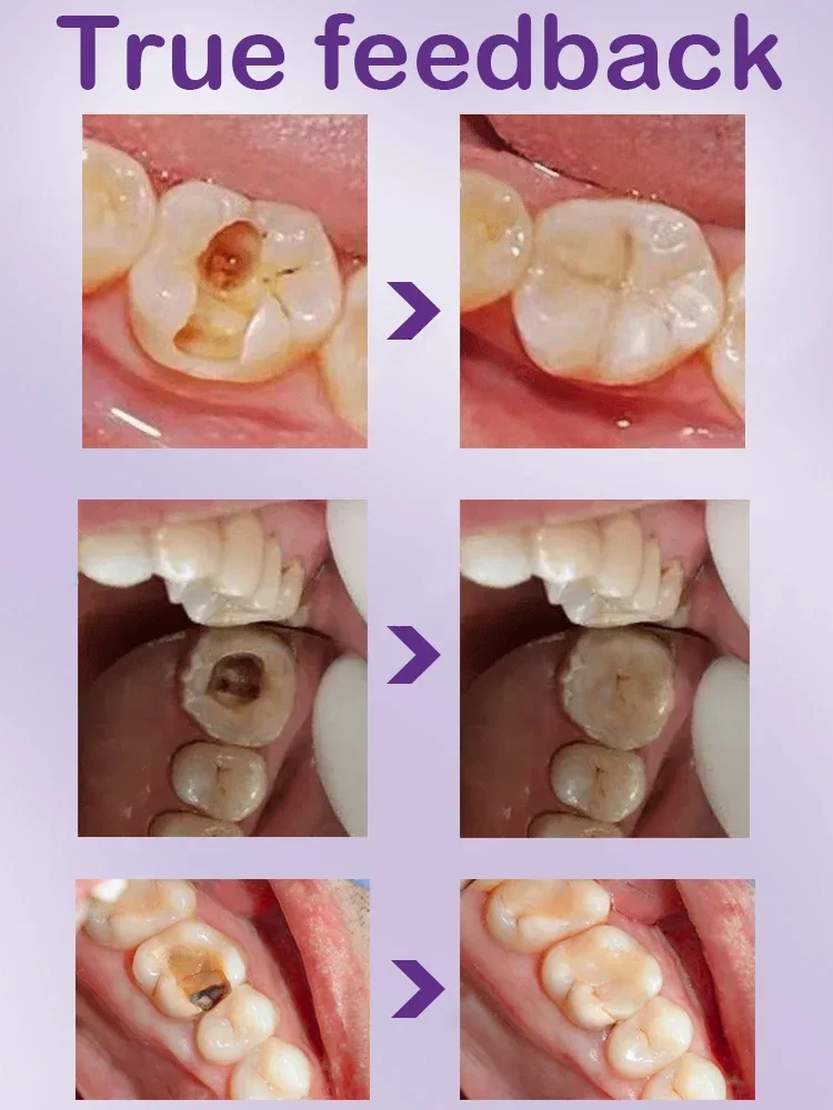 Teeth Health Product Anti Decay Toothpaste Dental Caries Repair Cream Prevent Tooth Decay Protect Teeth 30g
