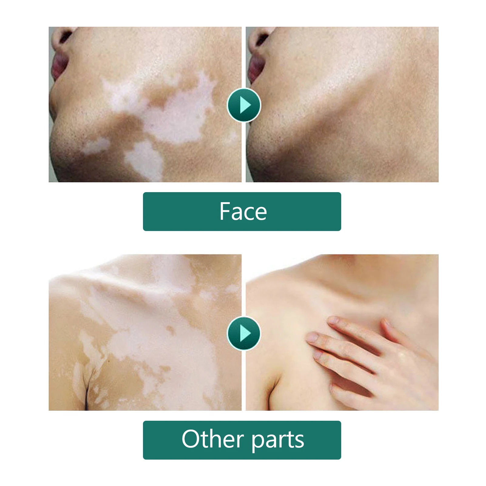 Waterproof Vitiligo Cover Liquid 20ml Makeup Concealer Cosmetics For Face Body liquid concealer makeup concealer waterproof concealer face concealer