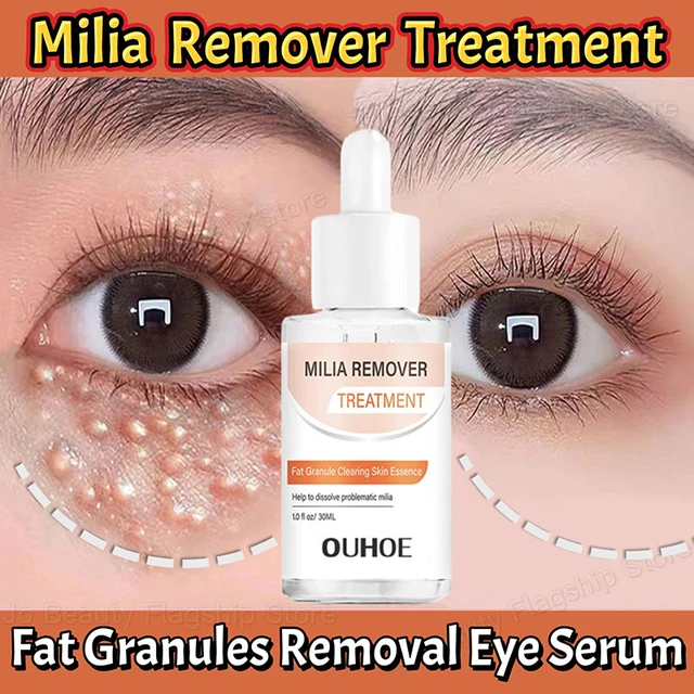 Fat Granules Removal Eye Serum Eye Milia Repair Treatment Products Wrinkle Lifting Moisturizing Anti-Puffiness Korean Skin Care 1
