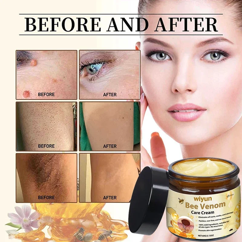 Bee Venom Skin Care Treatment Cream,Herbal Formula Soothing Nourishing Moisturizing Skin,Remove Scars And Spots Skin Savior
