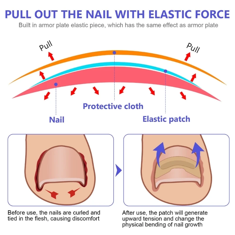 Toenail corrector patch 100pcs paronychia correction ingrown tools pedicure removal stickers