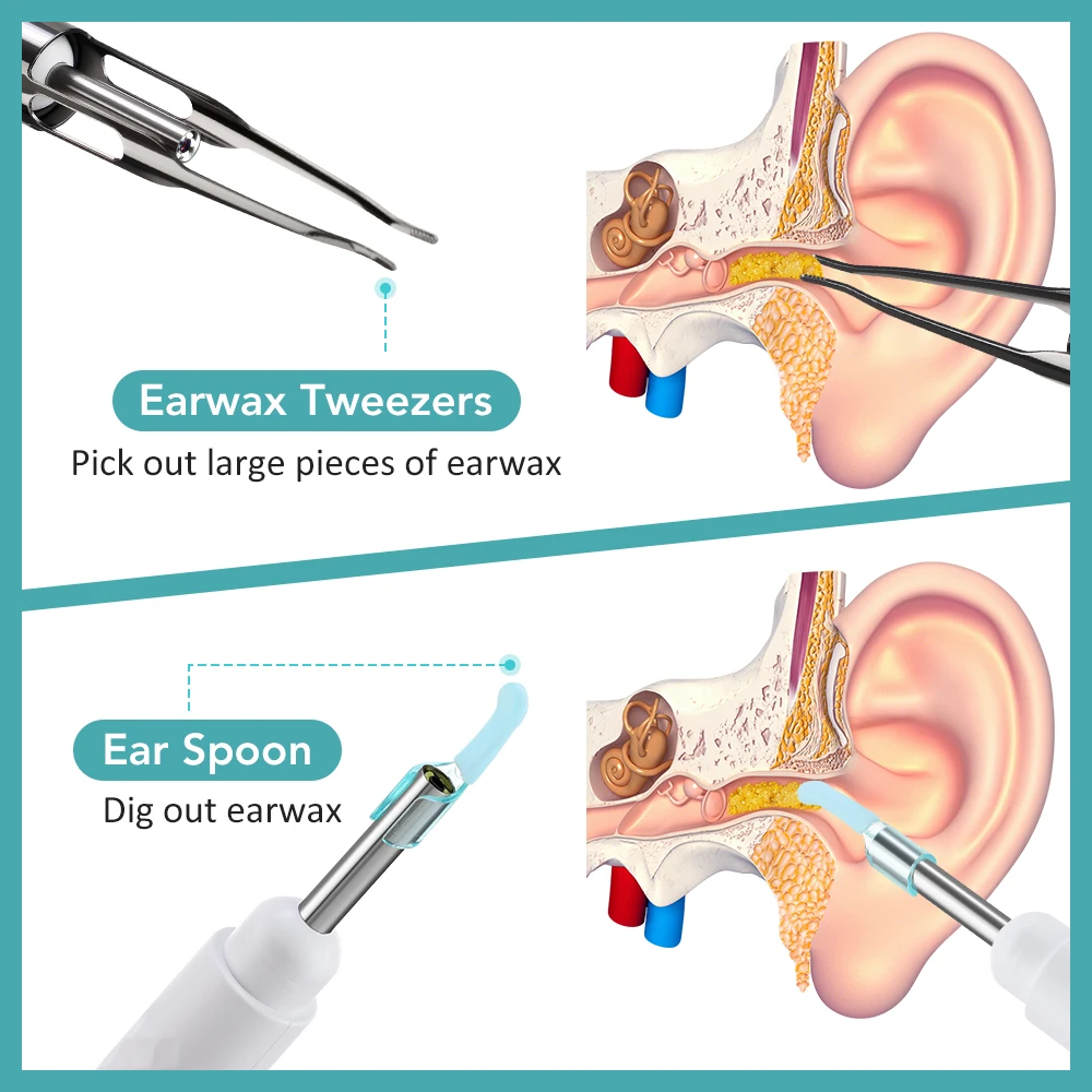 스마트 비주얼 귀지 제거기 카메라 포함 귀지 제거 도구 키트 2-in-1 귀이개 & 핀셋 HD 내시경 귀지 제거기