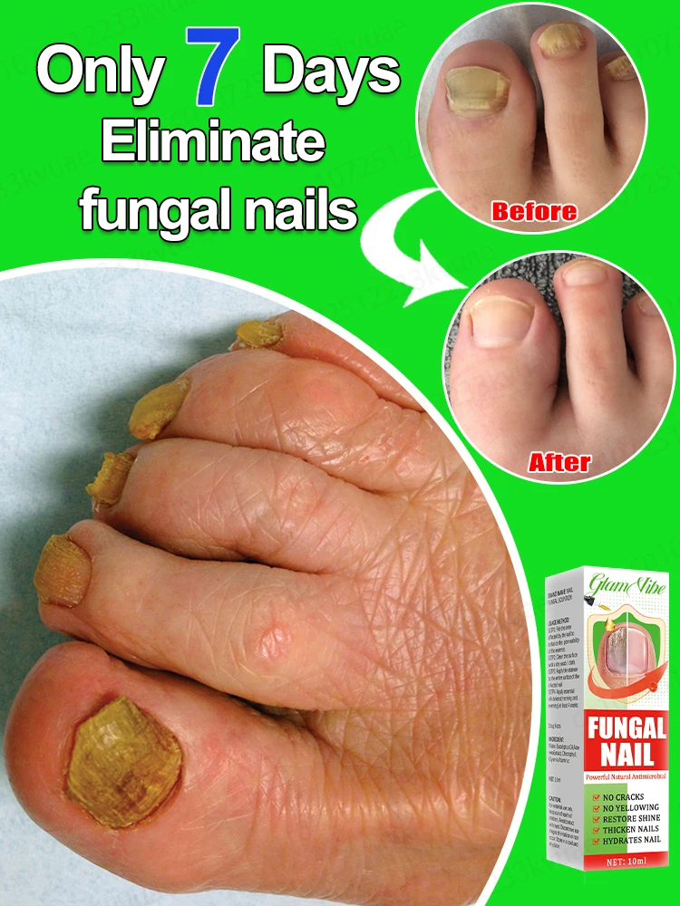 Fungus Solution Nail fungus treatment essential oil repair onychomycosis in 7 days