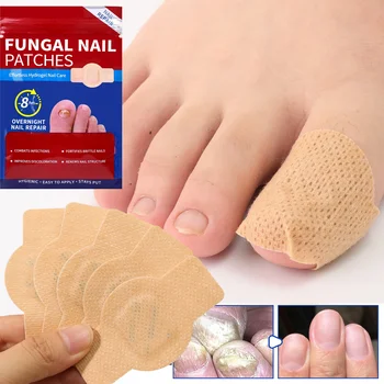 21pcs Waterproof Nail Fungus Patch Ingrown Toenail Correction Sticker Damaged Gray Nail Repair Care Feet Tools 1