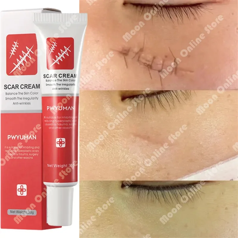 

Scar Removal Cream Gel Remove Acne Spots Treatment Stretch Marks Burn Surgical Scars Repair Cream Smooth Whitening Skin Products