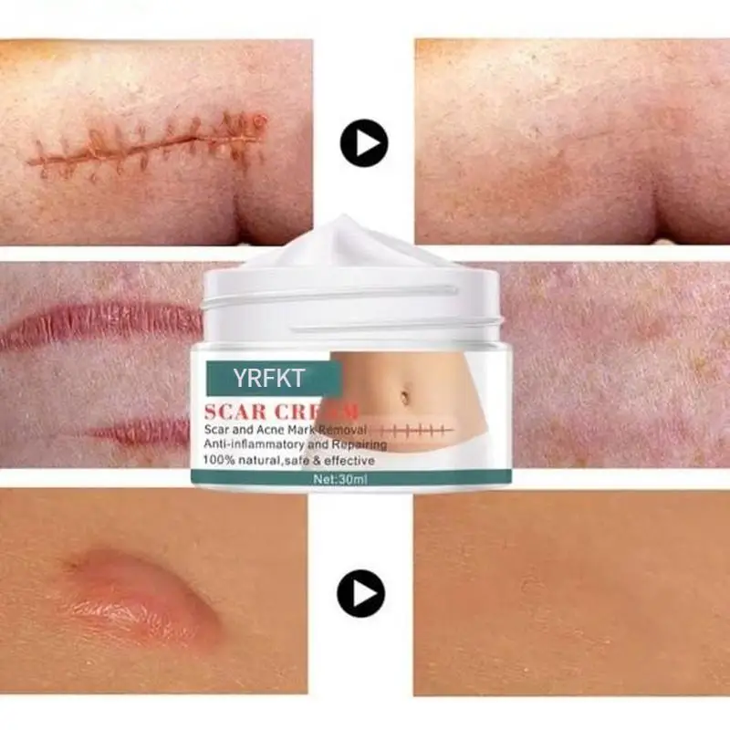 

Deeply Permeate Cuticle Skin Care Acne Stretch Scar Cream