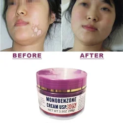 Monobenzone 60% Whitening Decolorizing Cream Clears Blemishes Fades Skin Tone Remove Melanin Leukoplakia Brightening 100g