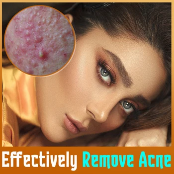 Gel anti-acné qui dilue les marques d'acné, apaise les rougeurs, balance le gonflement, contrôle de l'huile, répare la peau claire