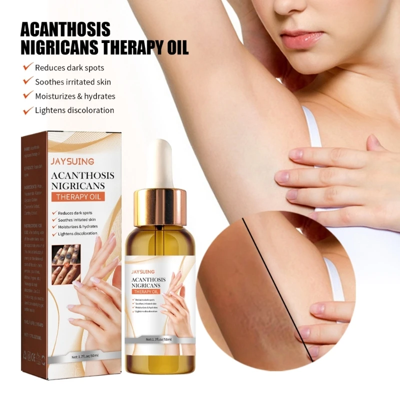 

Acanthosis Nigricans Treatments Oil Acanthosis Nigricans Therapy Oil Dark Knees