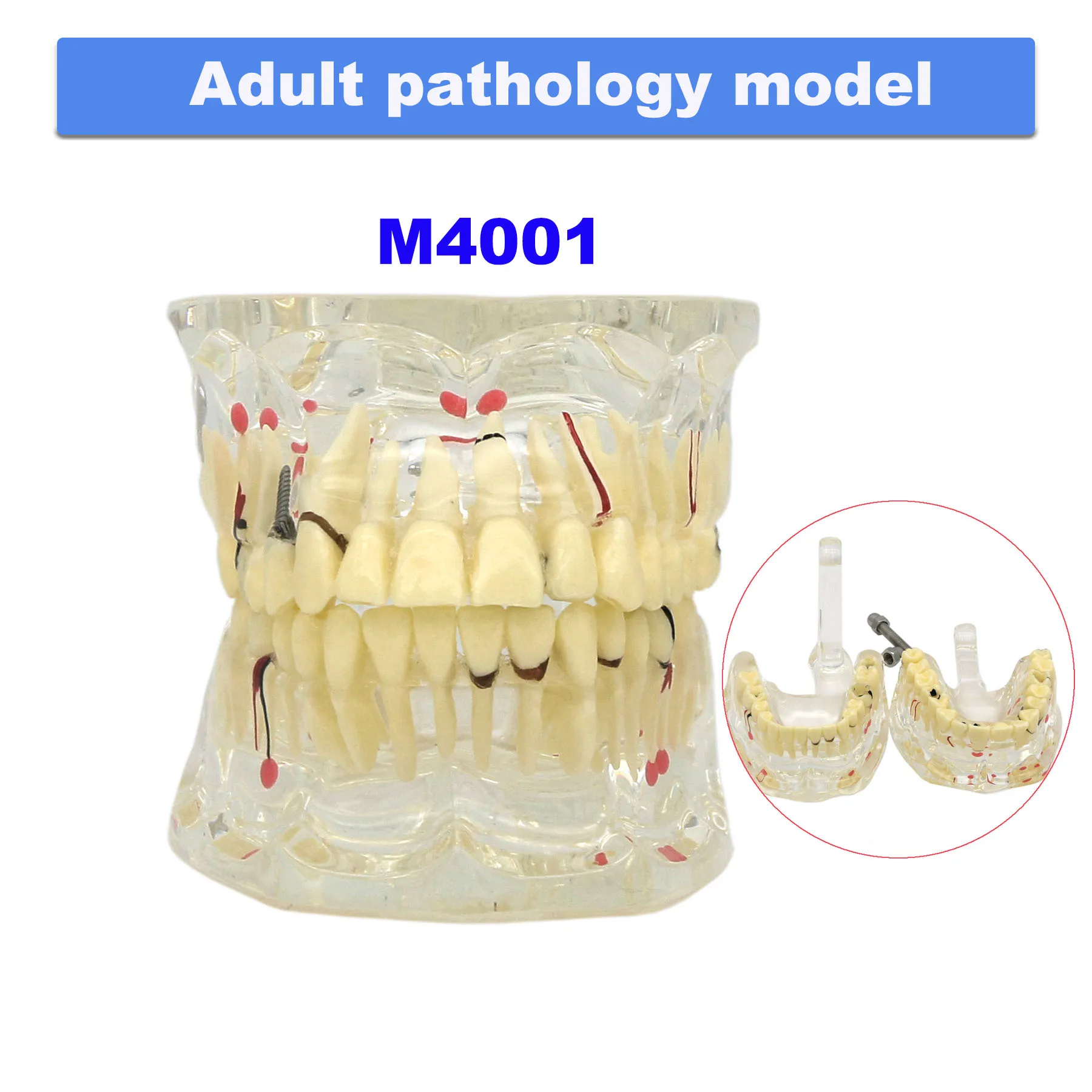 

Dental Pathology Teeth Model Adult Implant/Children Carious Cysts For Dentistry Study Teach Demo Science Disease