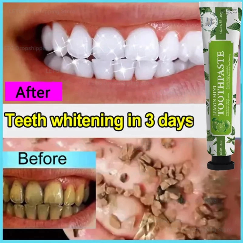 Remover Dental Calculus Dentifricio Rimuovi Denti Gialli Alitosi Pulizia Placca Sbiancamento Delle Macchie Dei Denti Prevenzione Parodontite
