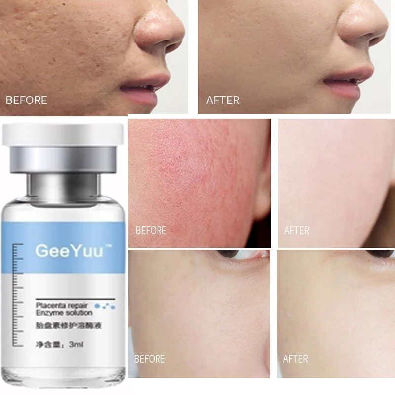 Oligopeptide Placenta Freeze-dried Powder Essence Repair Facial Moisturiz Hydrating Pore Shrinkage Skin Rejuvenation Skin Care 3