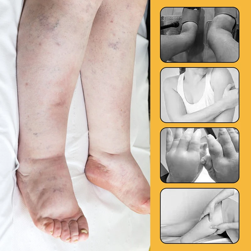 Edema Remove Patch Swelling Leg Foot Thigh Body Treatment Antiedematous Acupoint Massage Pain Relief Medical Plaster 10/30Pcs