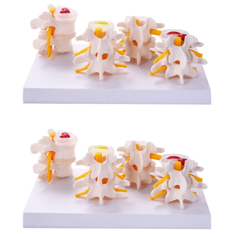 

2X Human Anatomy Skeleton Spine 4-Stages Lumbar Vertebral Model Brain Skull Traumatic Teaching Supplies