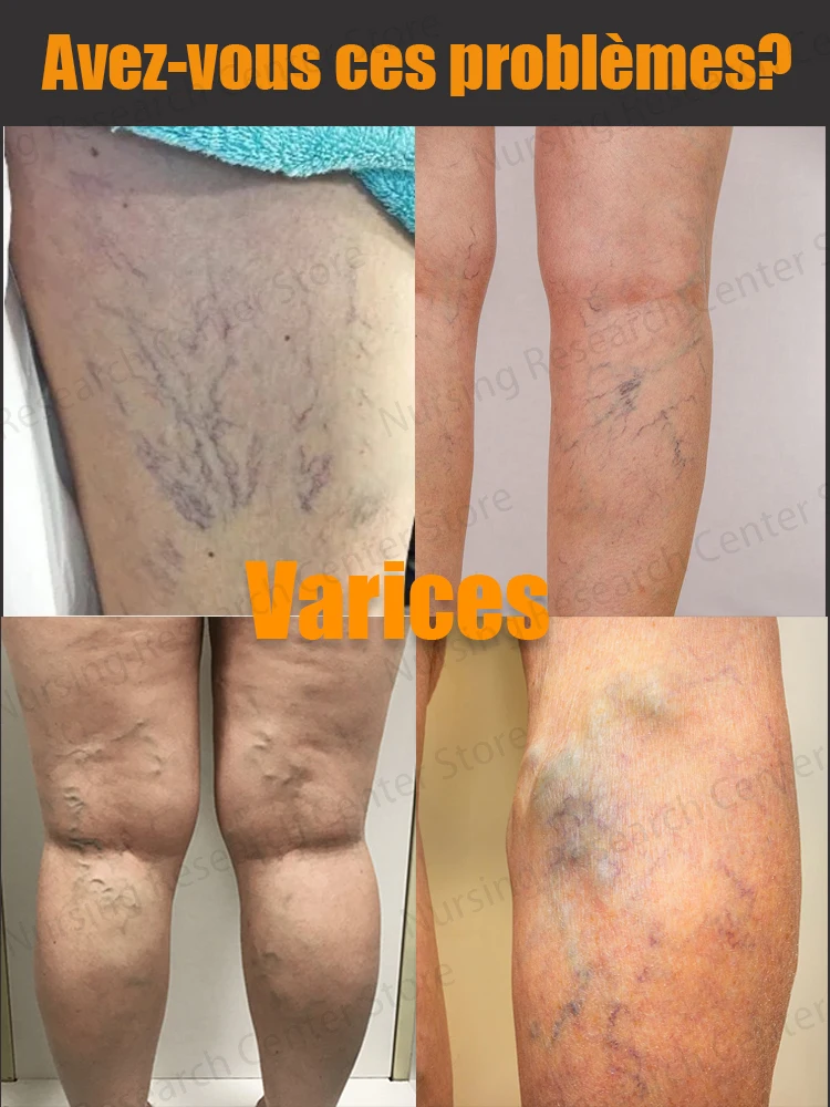 Pulse Massage Patch Eliminates Varicose Veins And Effectively Improves Blood Circulation_voghion.com