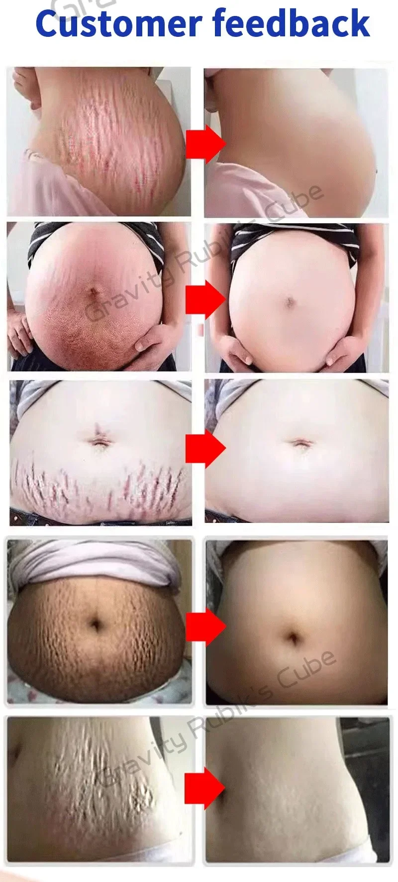 Description Picture 5 of itemStretch Mark Permanent Remover cream Removal Cream White Stretch Mark Remover Stretch Mark Remover