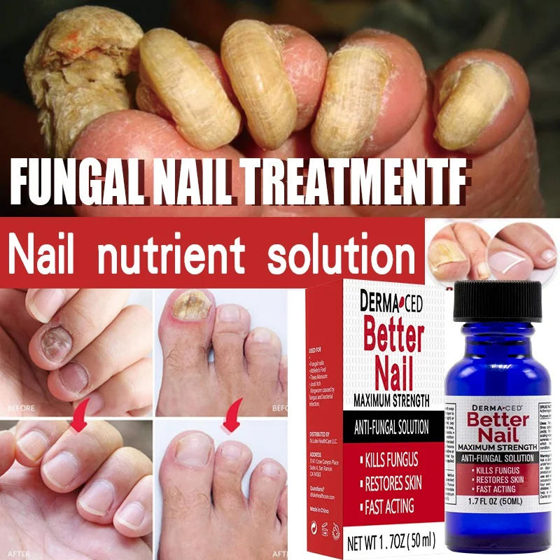 Finger Toenail Nail Repair Fungus Treatment Removal Feet Care Essence