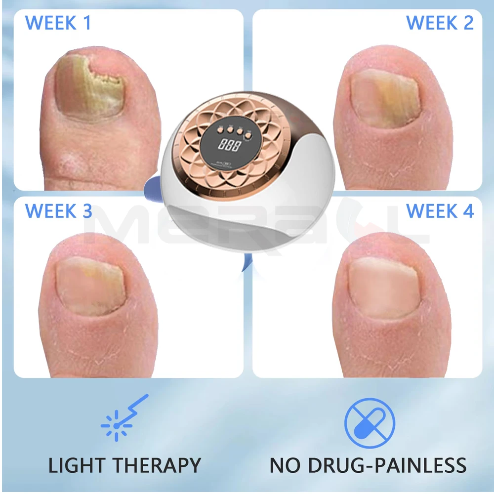 Nail Fungus Laser Device Painless Anti Onychomycosis Toenail Fungal Cleaning Machine Finger Nail Care Toenail Fungal Treatment