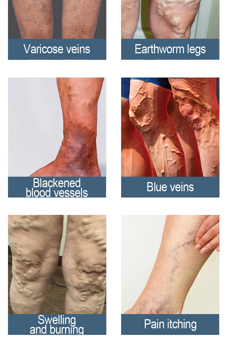 Laser Vein Therapy Device