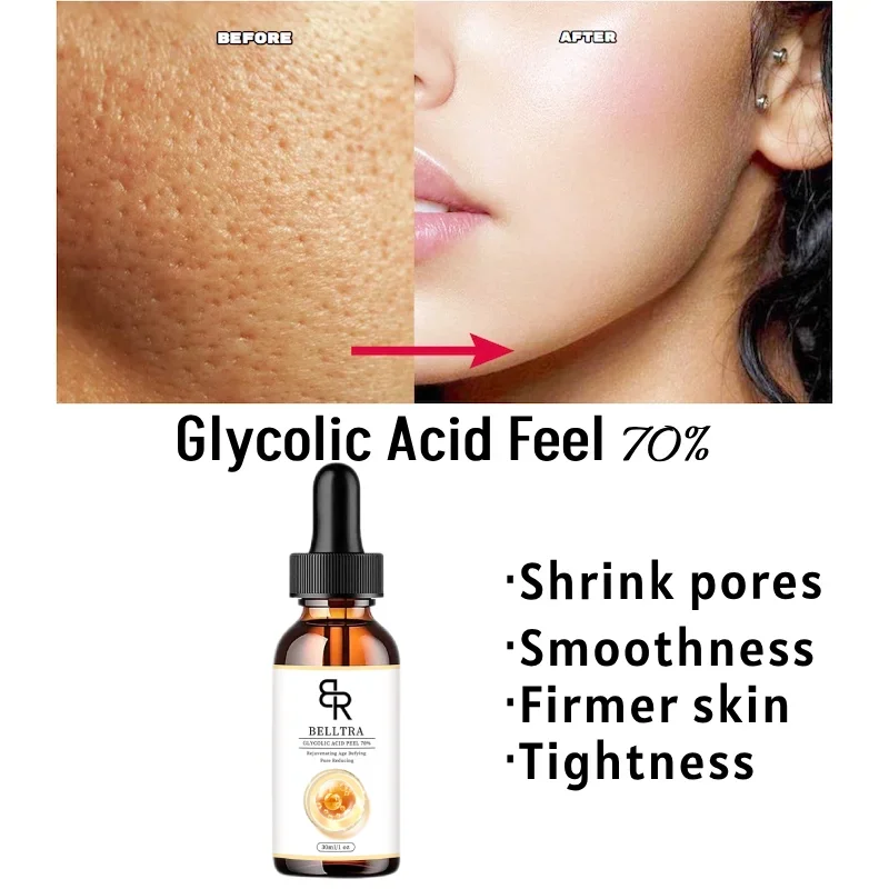 70% Glycolic Acid Chemical Peel Anti-Aging Brightening Smoothing Fine Lines Skin Pigmentation Acne Scars 30ml