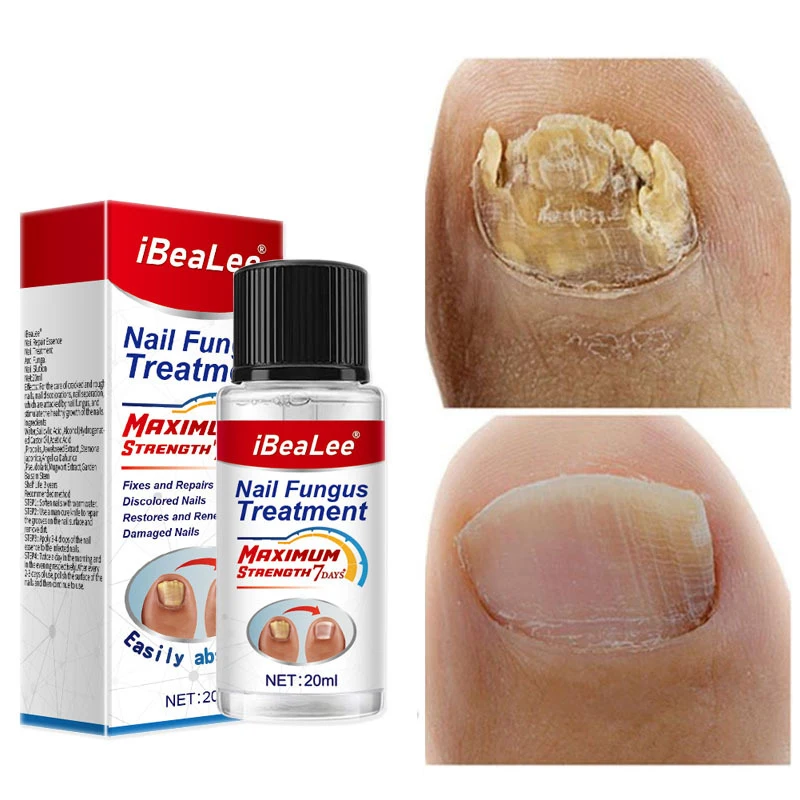 

Nail Fungus Treatment Essence Serum Care Oil Hand And Foot Care Nails Fungal Cuticle Oil Removal Repair Gel Anti-Infective Oil