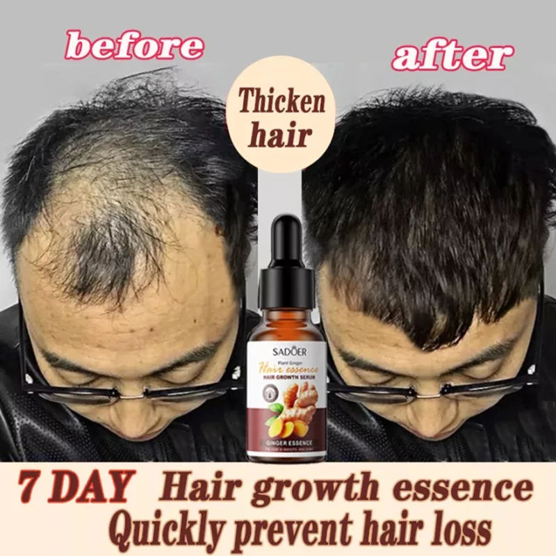 Ginger Hair Growth Oil Hereditary Hair Loss Seborrheic Alopecia Treatment  Fast Grow Prevent Hair Dry Frizzy Damaged Repair Care| | - AliExpress