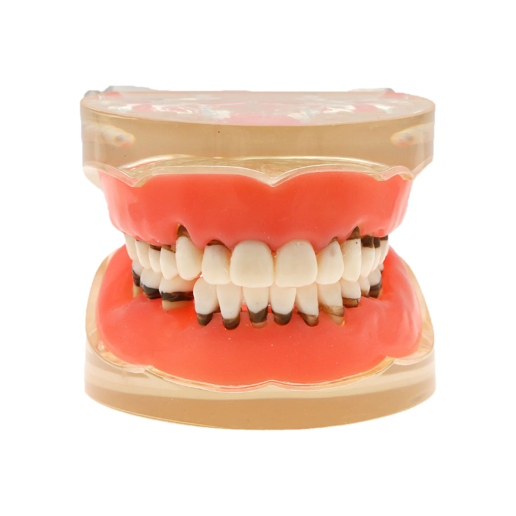 Dental Teeth Model  Dentist Teaching Model Demonstration Periodontal Disease Pathological For Patient Education Demo M4017 2
