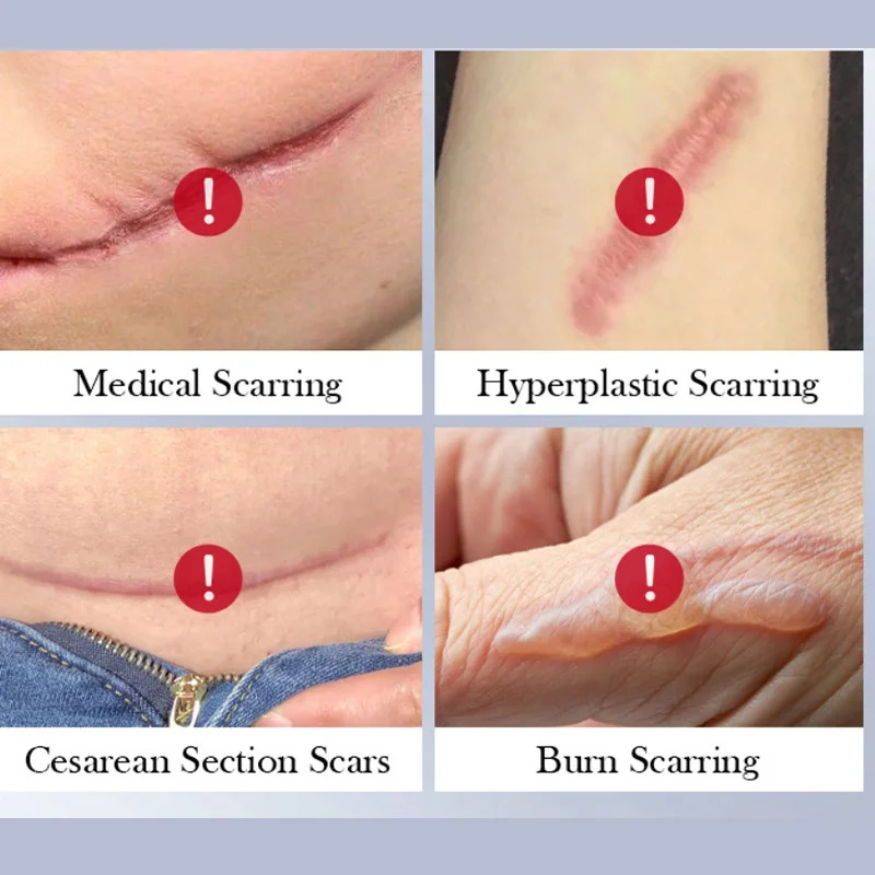 1/2/3 قطعة كريم إصلاح الندبات إصلاح تحرق ترطيب تجد...