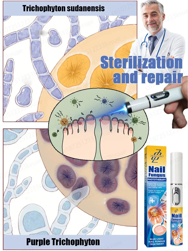 Technology changes pain effectively treats onychomycosis and nail fungus refuses drug treatment