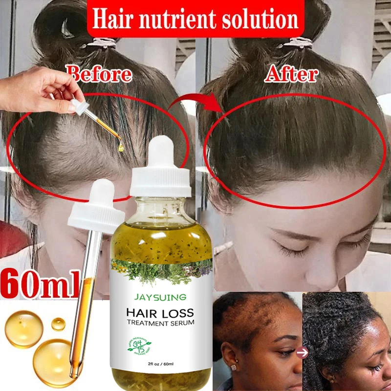 Fast Hair Growth Serum African Crazy Traction Alopecia Anti Hair Loss Essential Oil Prevent Baldness Scalp Treatment Hair Care rosemary hair growth serum 100% african crazy traction alopecia anti hair loss essential prevents bald thinning hair care oil