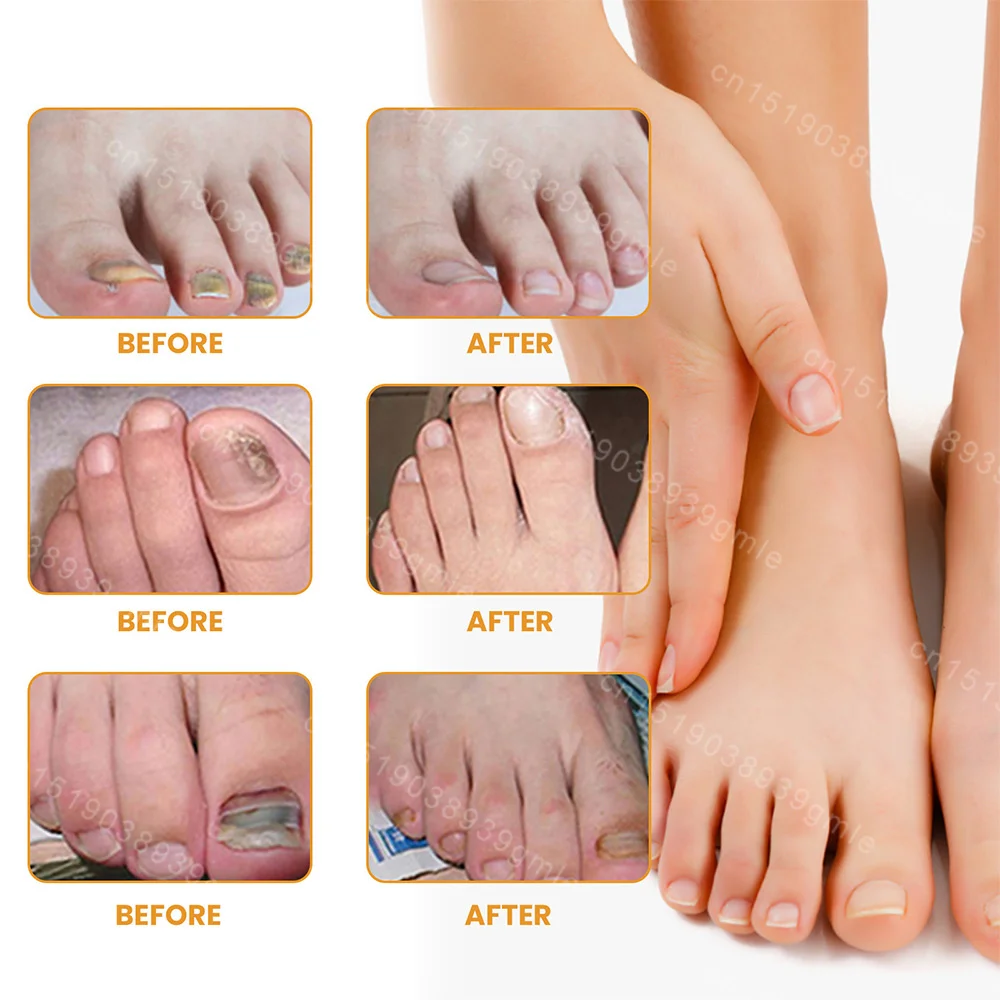 Toenail Fungus Patch Nail Repair Patches Nail Ingrown Correction Stickers for Discolored or Damaged Nails Sticker Toenail Care