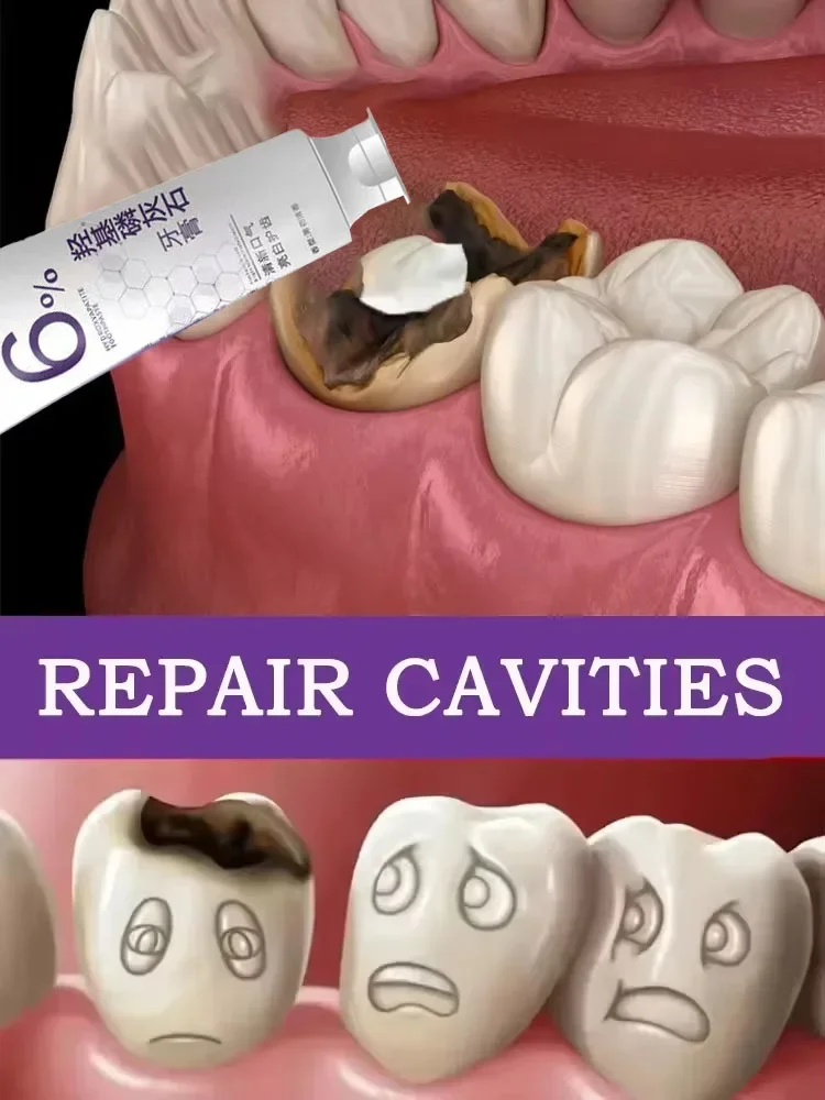 Anti Caries Repairing Cavities Tooth Decay Repair teeth health product