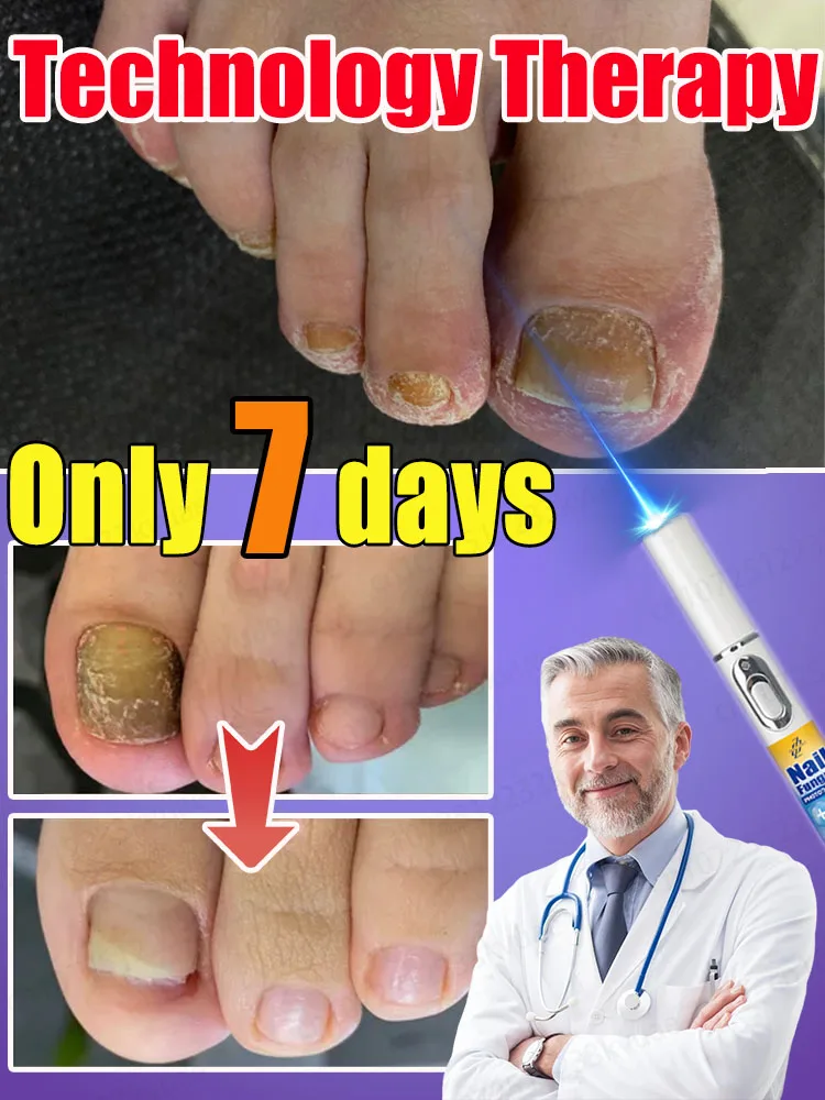 Technology changes pain effectively treats onychomycosis and nail fungus refuses drug treatment