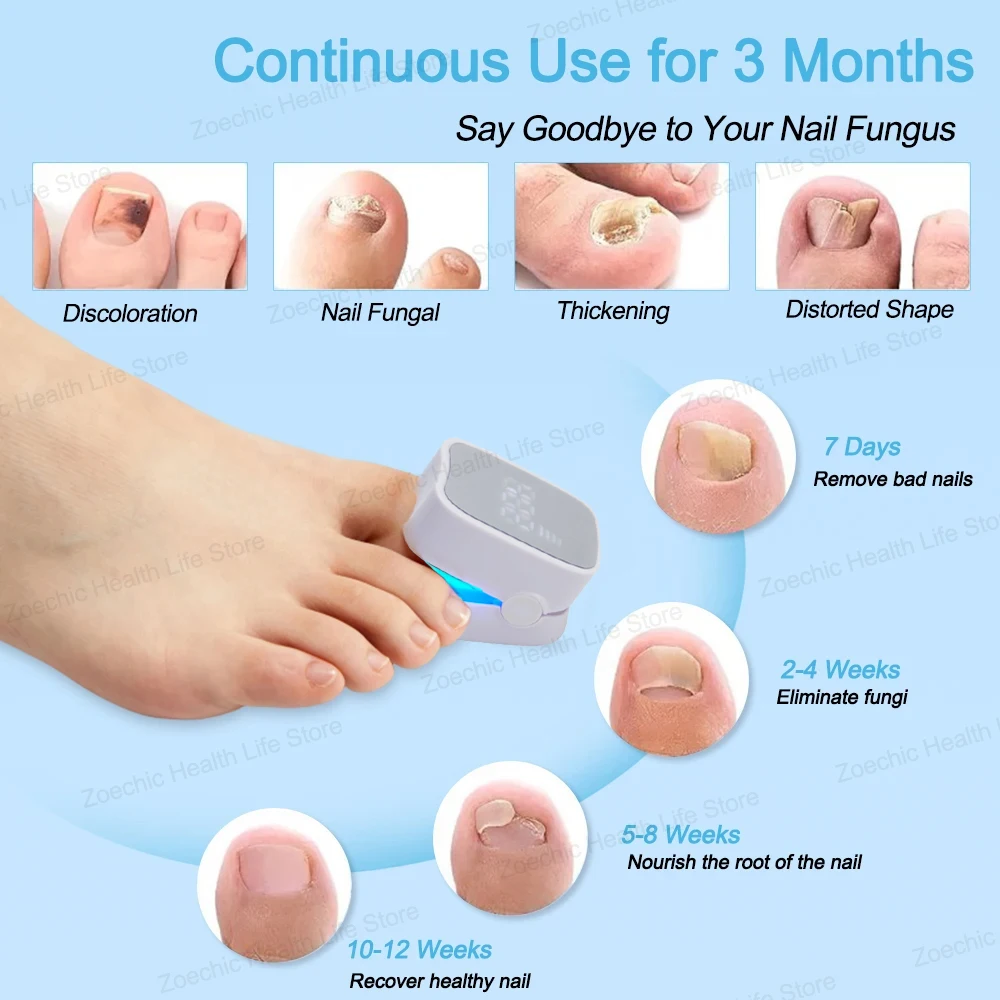 Fungal Nail Treatment Laser Device Time Display Blue Light Therapy for Fingernails and Toenails Onychomycosis Cure Machine nail fungus remover