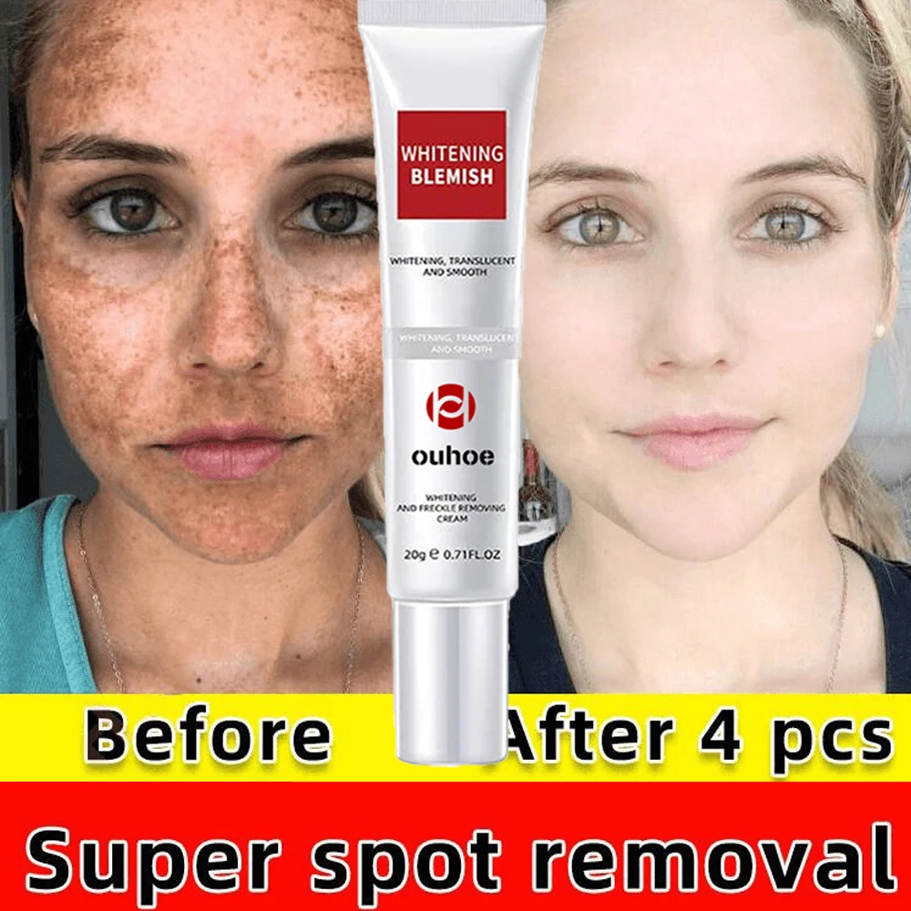 Effective Whitening Freckle Cream Remove Dark Spot Face Cream Removal Melanin Melasma Lighten Brighten Skin Care Korea Cosmetic professional freckle removal whitening set to remove melanin brighten skin tone remove freckles chloasma korean facial care