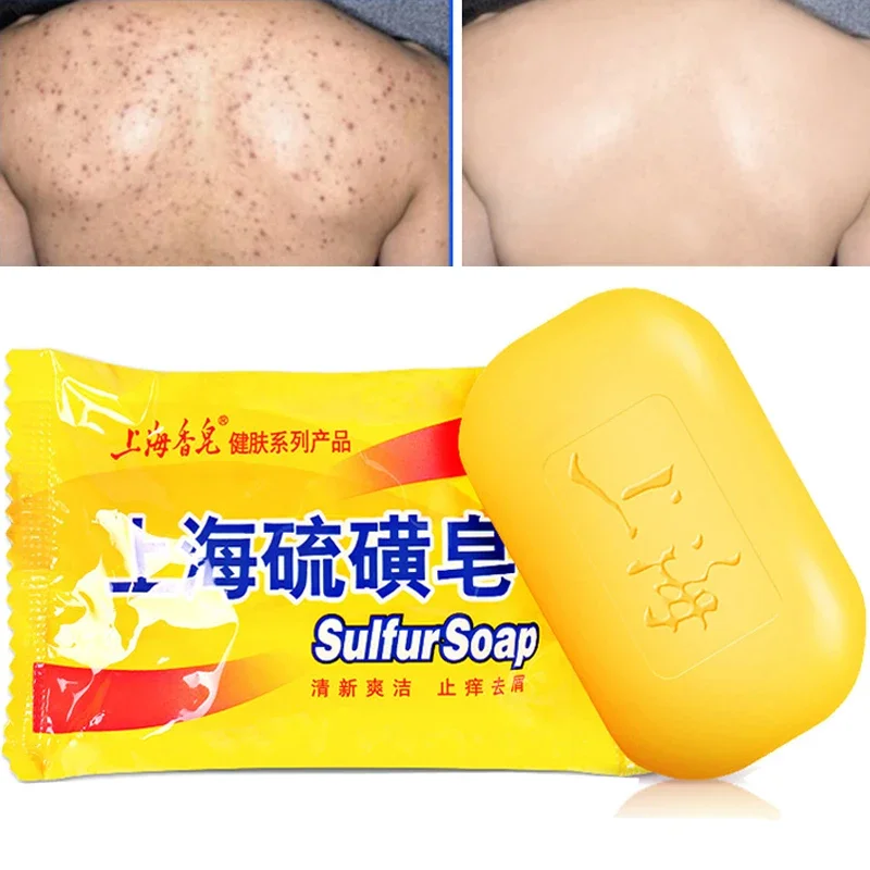 85g Shanghai Sulfur Soap Acne Treatment Psoriasis Seborrhea Eczema Anti Fungus Bath Healthy Soap