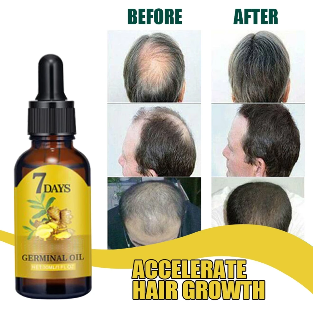 Ginger Hair Loss Treatment Fast Hair Regrowth Essential Oil 7 Days Anti