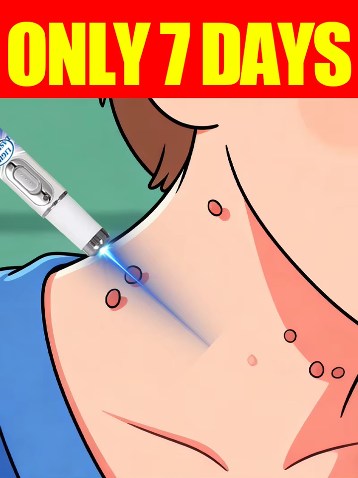 Generation-3 Laser Says Goodbye To Warts In 7 Days