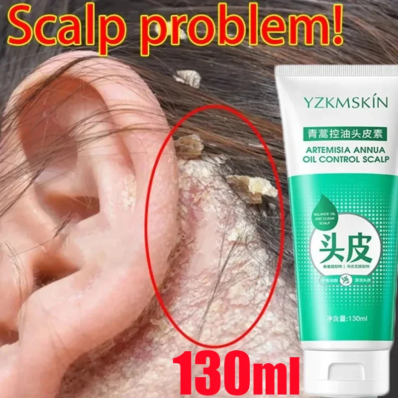 

Fast Anti Dandruff Hair Scalp Shampoo Treatment Itching Flaking Scalp Psoriasis Seborrheic Dermatitis Oil Control Cleansing Hair