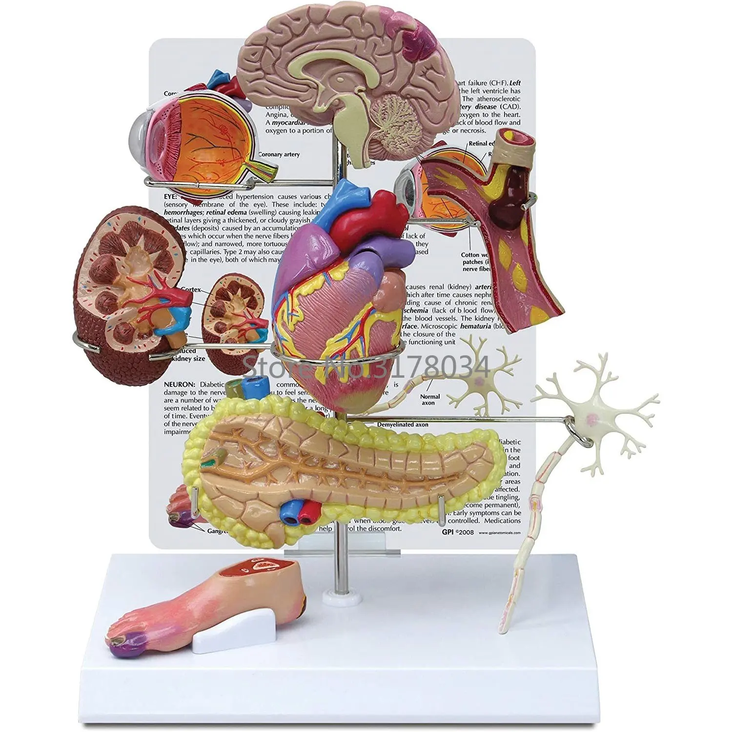 Type II Diabetes Model Set 1