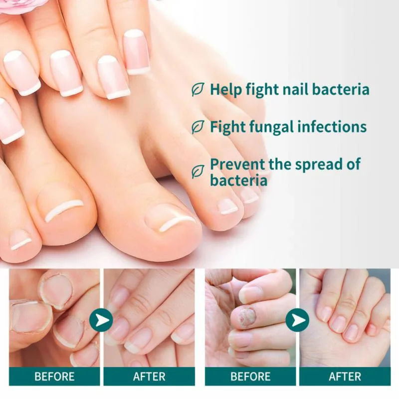 Nail Fungus Treatments Serum Spray Repair Toe Nail Fungal Removal